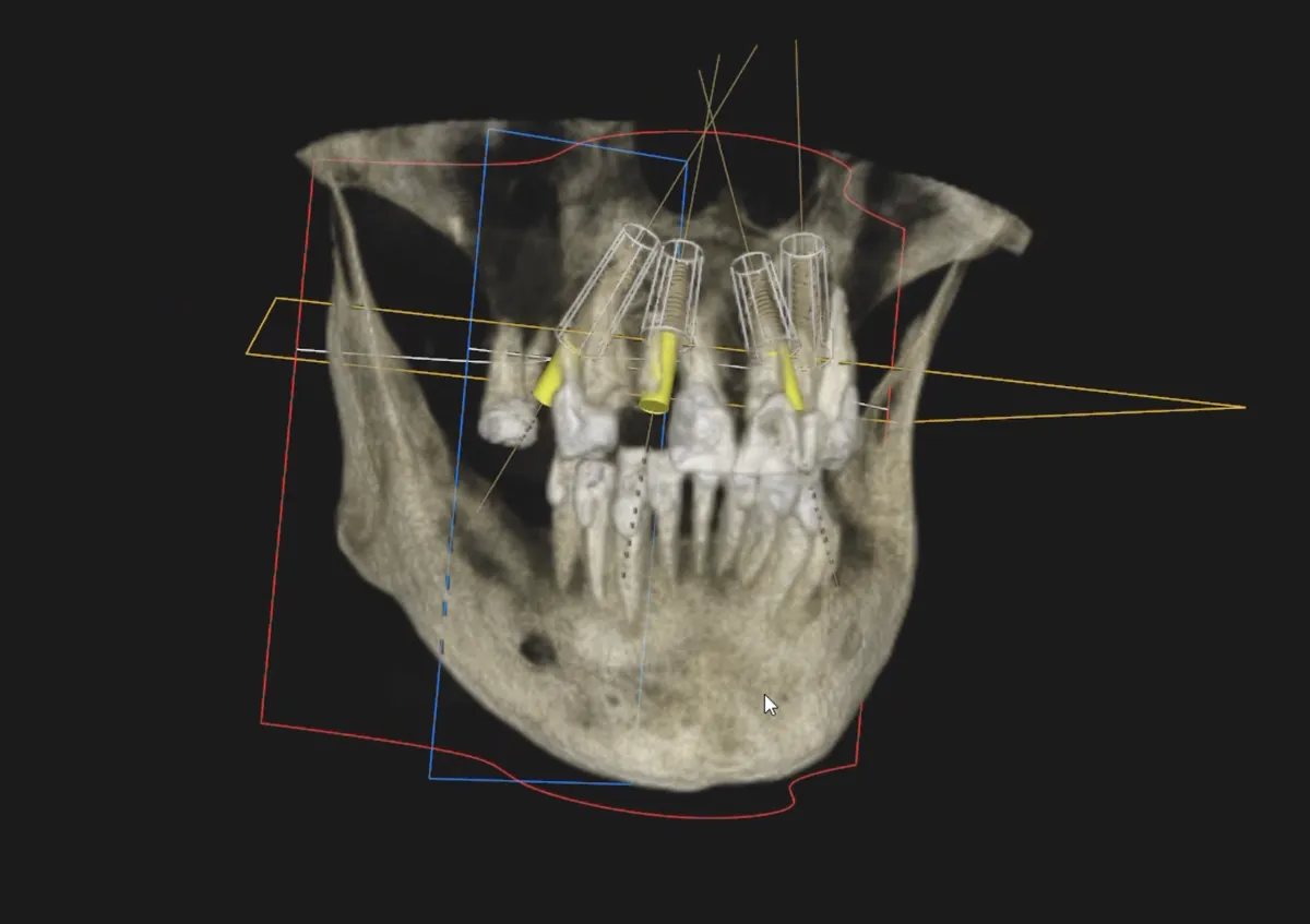 3D implant planning: CBCT volumetric scan with planned implant positions